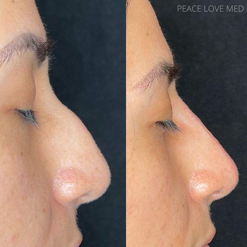 Expect After a Non Surgical Nose Job Before and After Big Nose