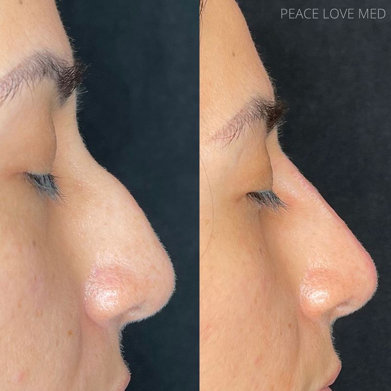 non surgical nose job