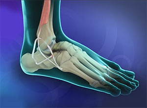 Ankle anchor surgery