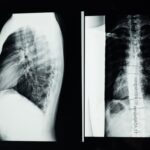 How car accidents affect patients with scoliosis